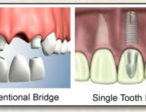 Implants & Dental Bridges